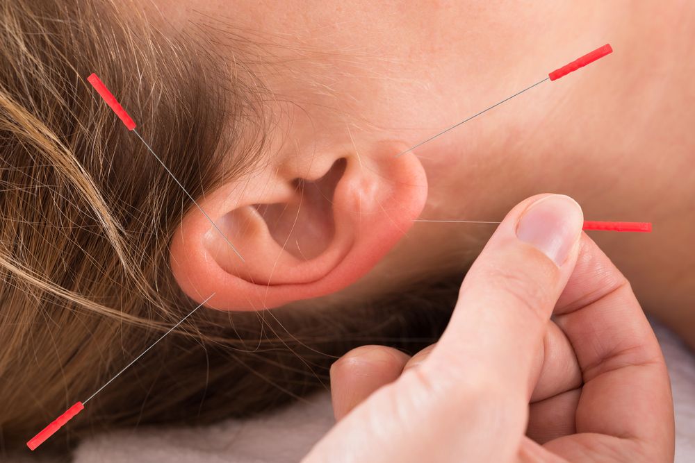 Auricular ear acupuncture treatment