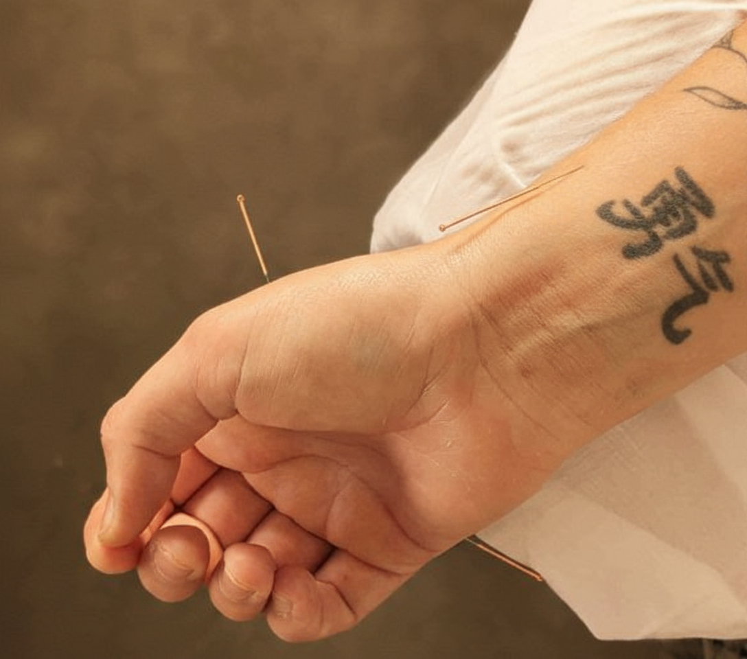 Acupuncture treatment with gentle needle placement