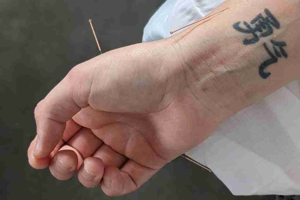 Acupuncture Therapy Benefits