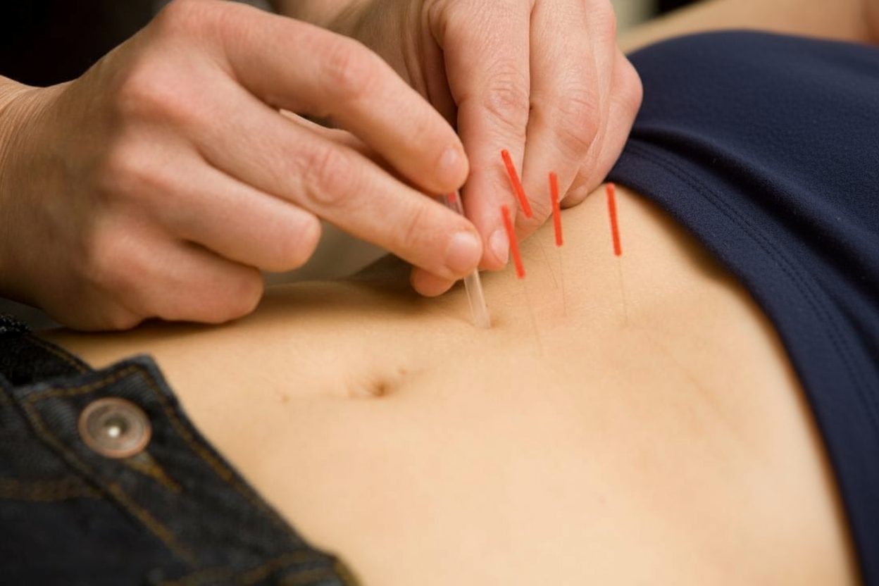 Fertility acupuncture treatment